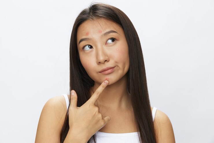 Masalah Kulit yang Kerap Muncul Selama Musim Hujan